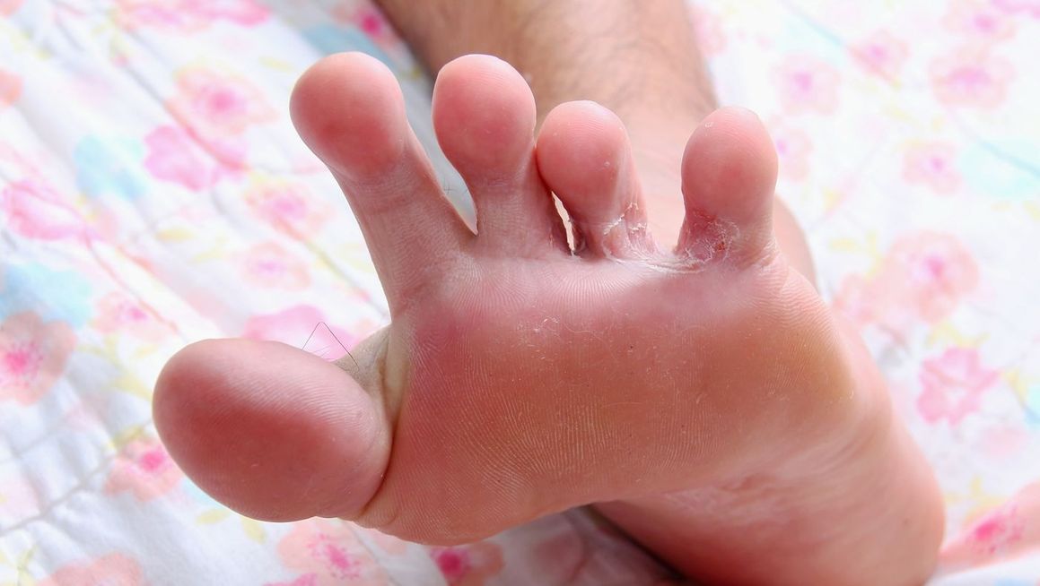 one of our patients with athletes foot